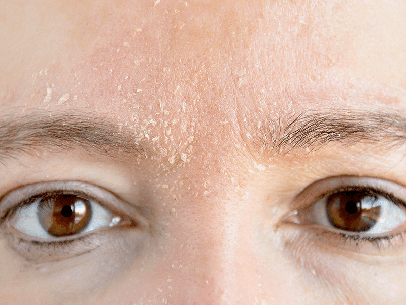 Eczema on eyebrows