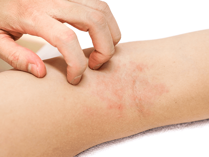 scratching eczema