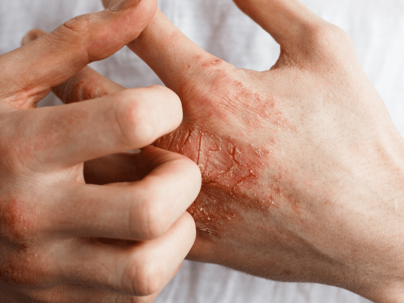 Eczema on hand
