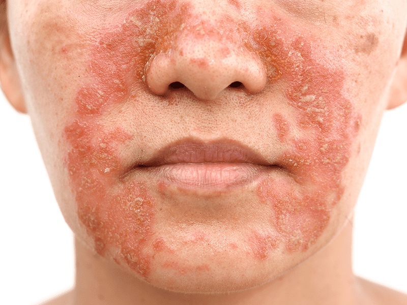 Eczema on patient face