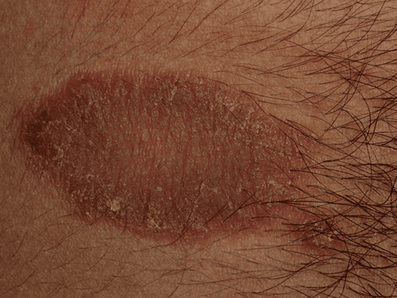 Exczema on skin