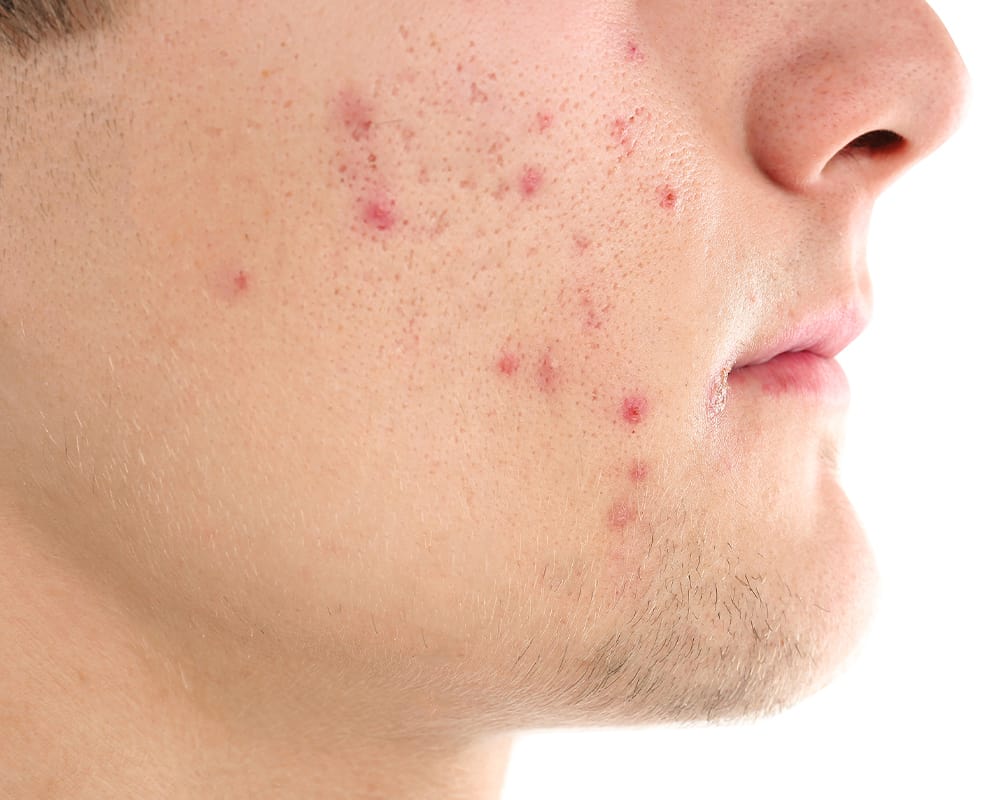 acne scar treatment